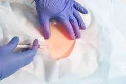 Epidural Steroid Injection Near Me